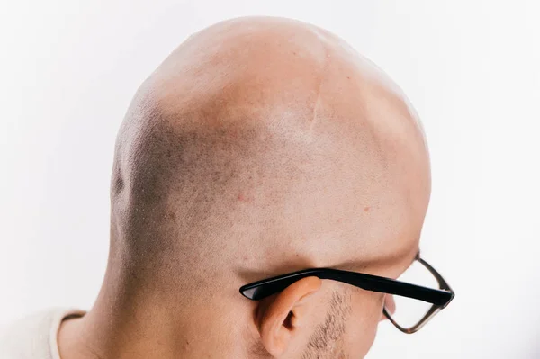 Homem Careca Óculos Após Cirurgia Neurocirurgia Oncológica — Fotografia de Stock