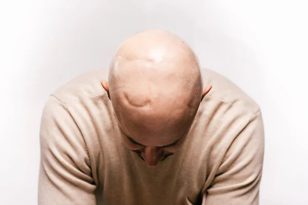 Skallig Man Med Psykisk Stress Kämpar För Livet Efter Cancer — Stockfoto