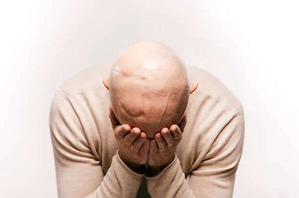 Bald man with psychological stress struggling for life after cancer neurosurgery operation