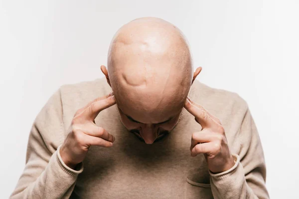 Bald man with psychological stress struggling for life after cancer neurosurgery operation