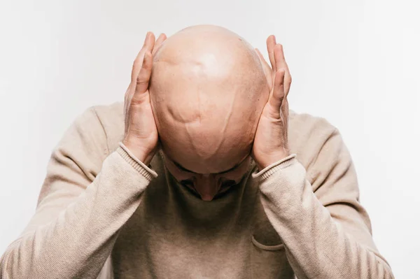 Hombre Calvo Con Estrés Psicológico Luchando Por Vida Después Operación — Foto de Stock