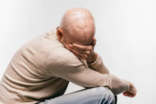 Homem Careca Com Estresse Psicológico Lutando Pela Vida Após Cirurgia — Fotografia de Stock