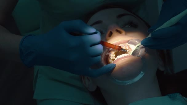 Использование отбеливающего геля для процедуры отбеливания зубов — стоковое видео