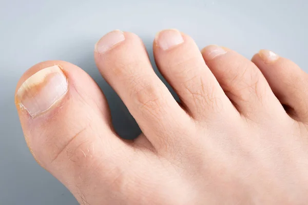 onychomycosis, Mycosis 'in ilk aşaması. Mantar bakterisi bulaşmış ayak parmağı