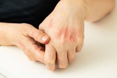 Deri iltihabı, alerji, şiddetli alerji. Cilt rengi bozulması, ellerin kaşınması. Tıbbi konsept. Yardım ve tedavi. Kapat.