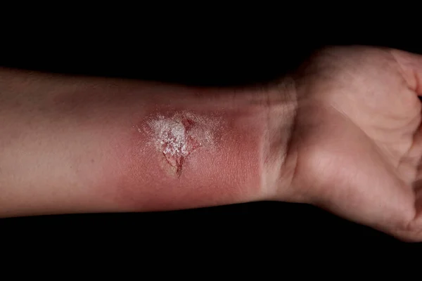 Queimadura Temperatura Braço Tratamento Ferida Mão Braço Ferido Pele Vermelha — Fotografia de Stock