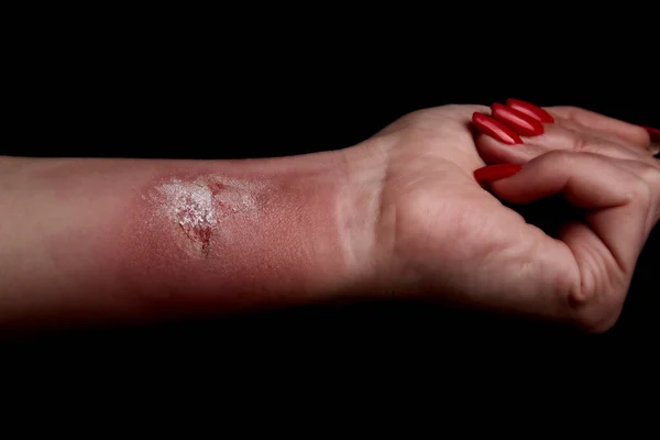 Quemadura Temperatura Brazo Tratamiento Heridas Mano Brazo Herido Piel Roja —  Fotos de Stock