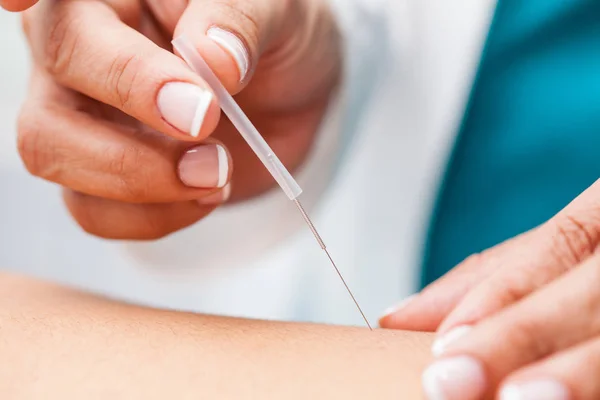 Médico Realizando Acupuntura Paciente Varón Joven —  Fotos de Stock