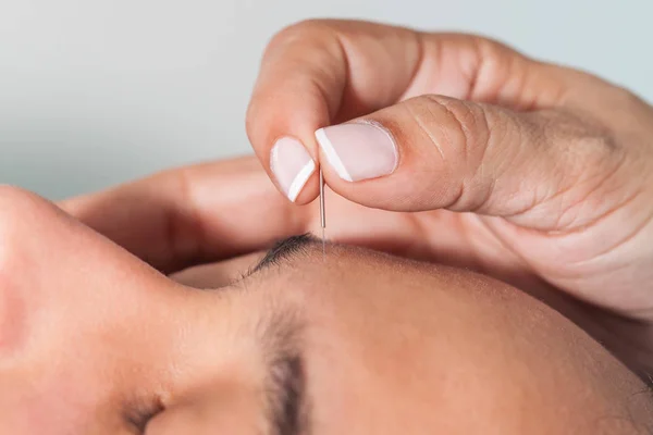 Läkare utför ansiktsbehandling akupunktur på en ung manlig patient — Stockfoto