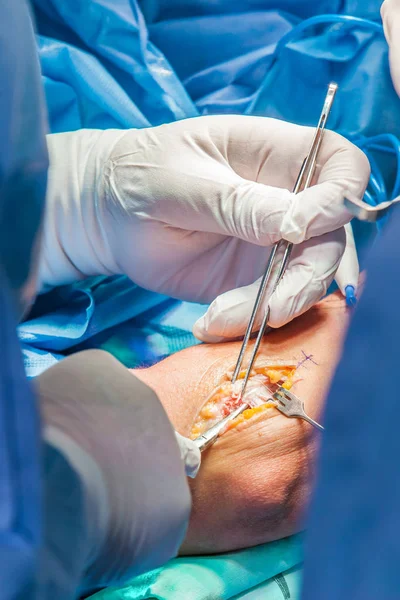 Grupo de cirujanos ortopédicos que realizan cirugía en un brazo de paciente — Foto de Stock
