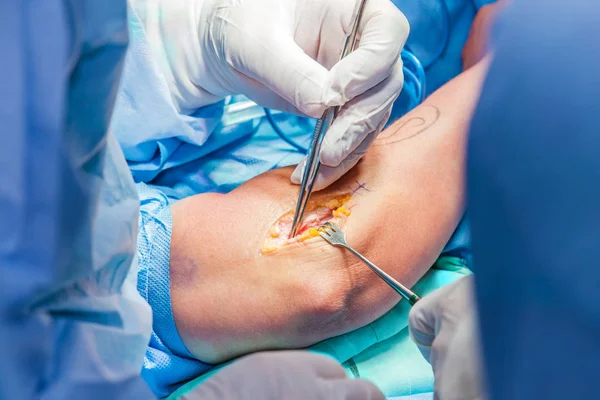 Grupo de cirujanos ortopédicos que realizan cirugía en un brazo de paciente — Foto de Stock