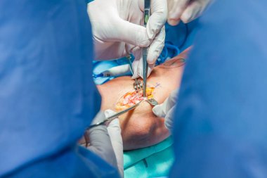 Hasta kolunda ameliyat yapan Ortopedi Cerrahları grubu