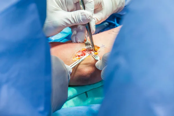 Gruppe orthopädischer Chirurgen, die am Arm eines Patienten operieren — Stockfoto