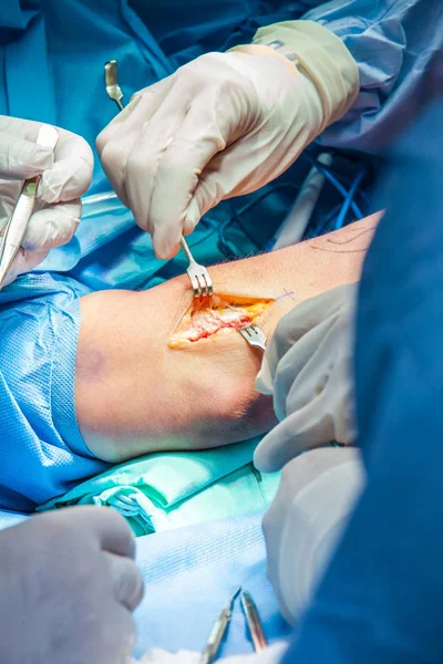 Grupo de cirujanos ortopédicos que realizan cirugía en un brazo de paciente — Foto de Stock