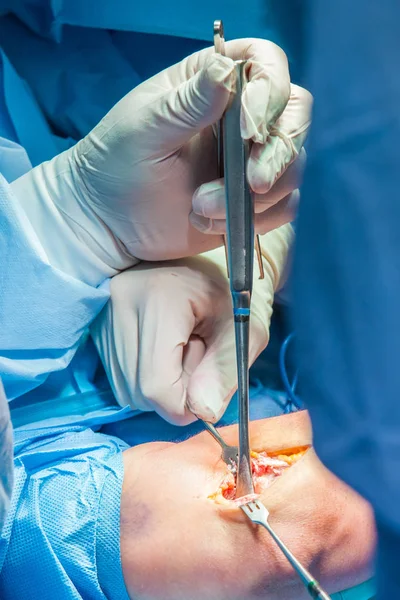 Groep orthopedische chirurgen die een operatie uitvoeren op een patiënt arm — Stockfoto