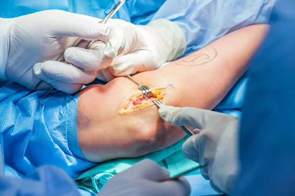 Grupa chirurgów ortopedycznych wykonujących operację na ramieniu pacjenta — Zdjęcie stockowe