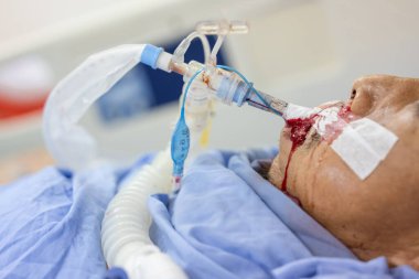 Ağzı ve burun boşluğu kanayan kriz hastaları kendilerine yardım edemiyorlar. Solunum cihazı her zaman gereklidir..