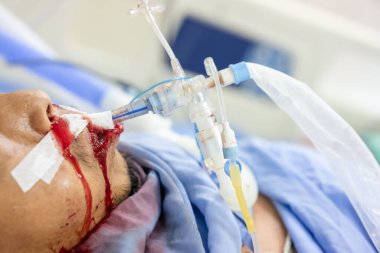 Ağzı ve burun boşluğu kanayan kriz hastaları kendilerine yardım edemiyorlar. Solunum cihazı her zaman gereklidir..