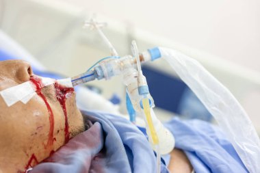 Ağzı ve burun boşluğu kanayan kriz hastaları kendilerine yardım edemiyorlar. Solunum cihazı her zaman gereklidir..