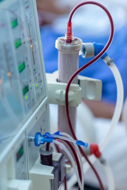 Diyaliz makinesi çalışıyor. Böbreklerin vücuttan atık taşımasının yerine geçiyor..