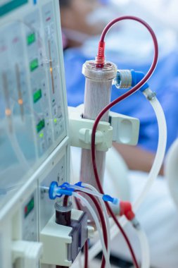 Diyaliz makinesi çalışıyor. Böbreklerin vücuttan atık taşımasının yerine geçiyor..