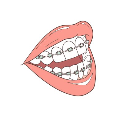 Diş teli, diş tasviri ve ortodontikle ağzını aç.