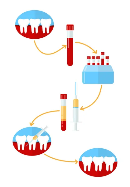 Infografías Fabricación Plasma Para Odontología Encía Sangrante Gingivitis Ilustración Vectorial — Archivo Imágenes Vectoriales