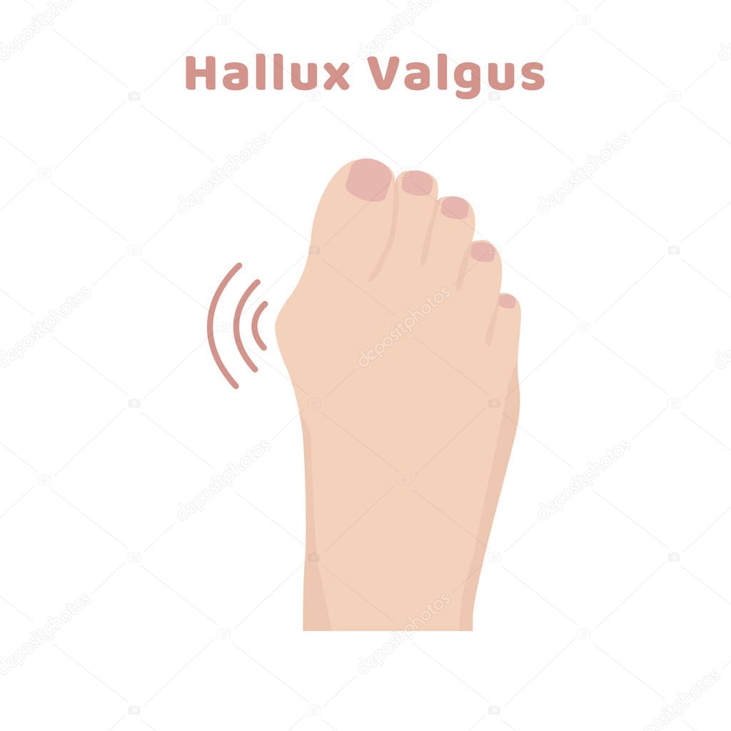 Deformity bunion bone of toe - Hallux valgus. Orthopedic disease