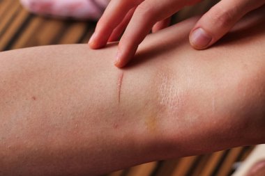 İnsan Kolu Derisinde İnce Beyaz Çizgili Yara Gün Işığında Hafif Morarma