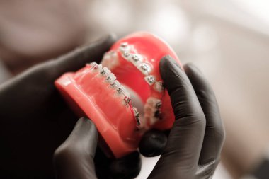 Dentist in black gloves holding Dental casting model human Jaws with braces in prosthetic laboratory. Dentistry, Orthodontics. Close up. selective focus clipart