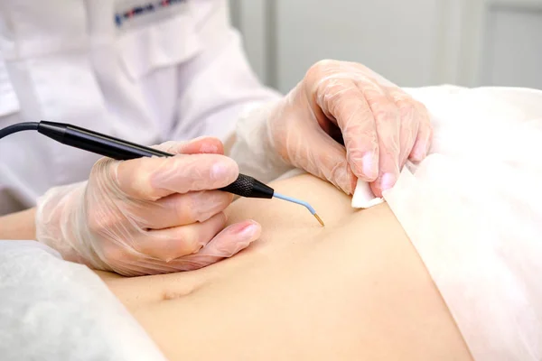 女性患者の胃からの母斑の内科的治療の除去 女性の皮膚科医は 腹のモルを除去するために電気焼灼器を使用します 電波電気凝固除去方法 — ストック写真
