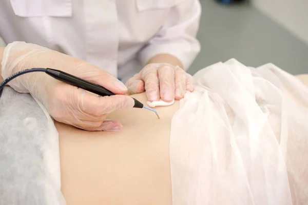 Lékařské Ošetření Odstranění Mateřské Značky Žaludku Pacientky Dermatolog Který Používá — Stock fotografie