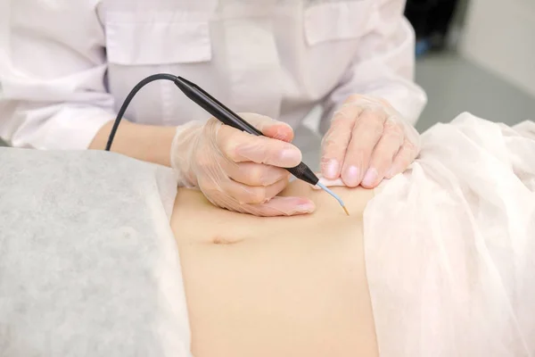 Tratamiento Médico Eliminación Marca Nacimiento Del Estómago Paciente Femenina Cirujano — Foto de Stock