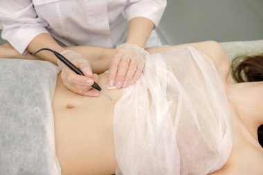 Kadın hastanın mide Doğum lekesi tıbbi tedavi kaldırılması. Kadın dermatolog cerrah göbek mol kaldırmak için elektrokoter kullanarak. Radyo dalgası elektrokoagulasyon kaldırma yöntemi