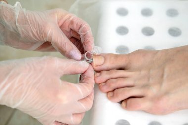 Dermatolog hastanın ayak tırnağı altından analiz için örnek alır. Dermatoloji, mantar enfeksiyonu. Yakın çekim