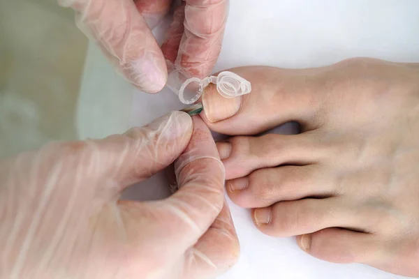 Dermatolog hastanın ayak tırnağı altından analiz için örnek alır. Dermatoloji, mantar enfeksiyonu. Yakın çekim