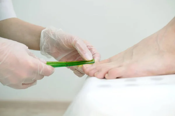 Dermatologista Mede Com Régua Para Análise Unha Paciente Dermatologia Infecção — Fotografia de Stock