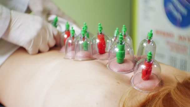 Tradycyjny proces bańki chińskiej medycyny. Kubki Hijamah na odwrocie kobiece kobieta pacjentów w terapii akupunktury. Chiński tradycyjny leczenie. Sprzęt do terapii medycznej bańki. — Wideo stockowe
