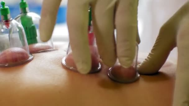 Traditionelle chinesische Medizin Schröpfverfahren. Hijamatassen auf dem Rücken einer Patientin in der Akupunkturtherapie. Traditionelle chinesische Behandlung. Medizinische Schröpfgeräte. — Stockvideo