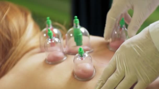 Medicina Tradicional Chinesa Cupping processo. Hijamah Copas nas costas de mulher paciente do sexo feminino em terapia de acupuntura. Tratamento tradicional chinês. Equipamento médico de terapia de copos . — Vídeo de Stock