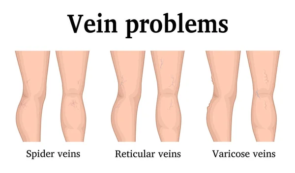 Tři Hlavní Problémy Žíly Nohách — Stockový vektor