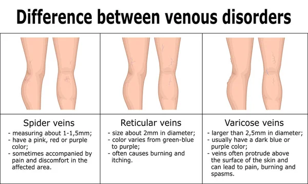 Illustrazione Della Differenza Tra Disturbi Venosi Quali Vene Ragno Vene — Vettoriale Stock