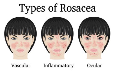 Three types of Rosacea - vascular, inflammatory and ocular for example depicted on the face of a young woman clipart