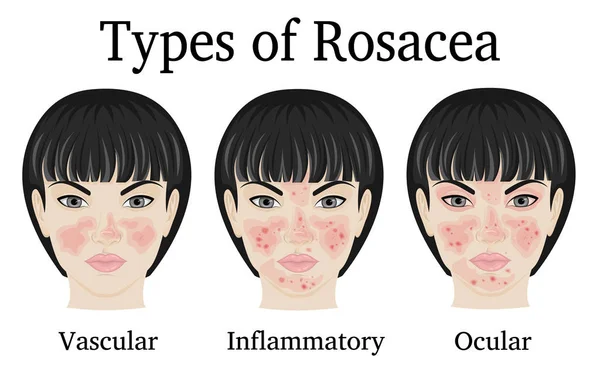 Rosacea - vasküler, enflamatuar ve oküler örneğin yüzünde genç bir kadın tasvir üç tür