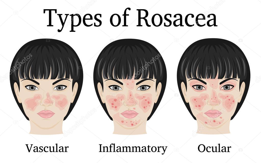 Three types of Rosacea - vascular, inflammatory and ocular for example depicted on the face of a young woman