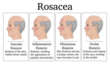 Four types of Rosacea - vascular, inflammatory, phymatous and ocular, for example depicted on the face of an elderly man clipart