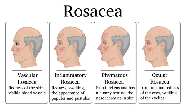 Четыре Типа Розацеа Сосудистые Воспалительные Фиматозные Глазные Например Изображенные Лице — стоковый вектор