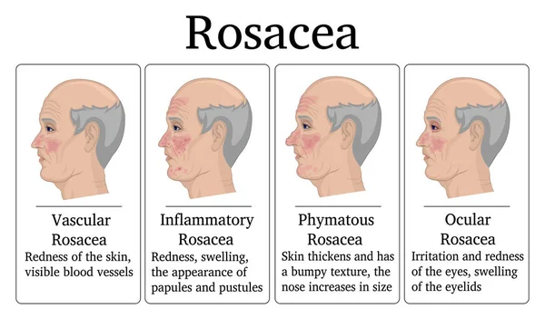 Four Types Rosacea Vascular Inflammatory Phymatous Ocular Example Depicted Face — Stock Vector