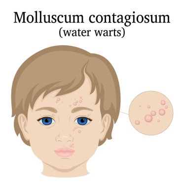 Molluscum contagiosum yüzünde küçük bir kız resmi