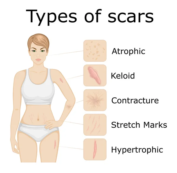 Illustration Five Types Scars Body Young Girl — Stock Vector